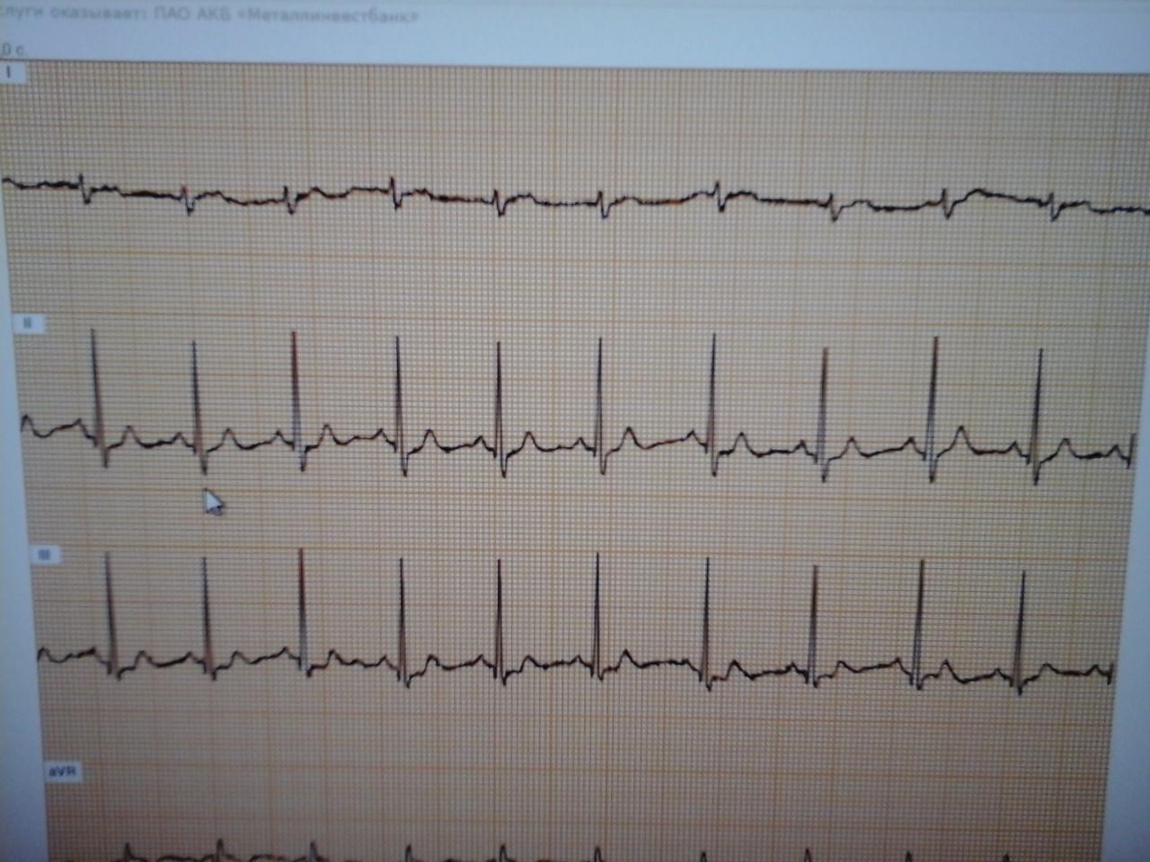 Экг стоя. Снимок ЭКГ С тахикардией. Тахикардия на ЭКГ расшифровка. Тахикардия на ЭКГ фото. Кардиограмма при тахикардии фото.