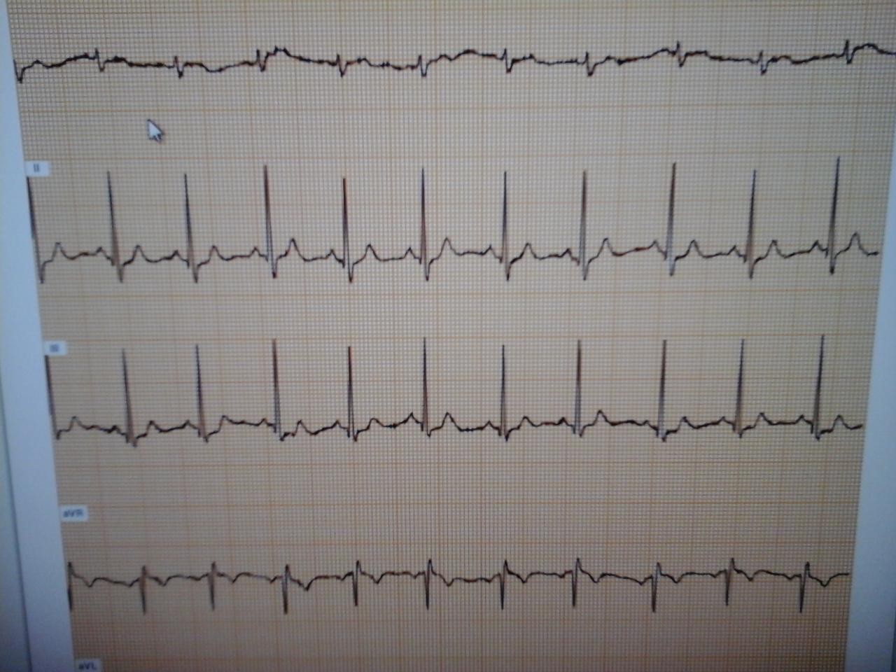 фото здоровой кардиограммы сердца