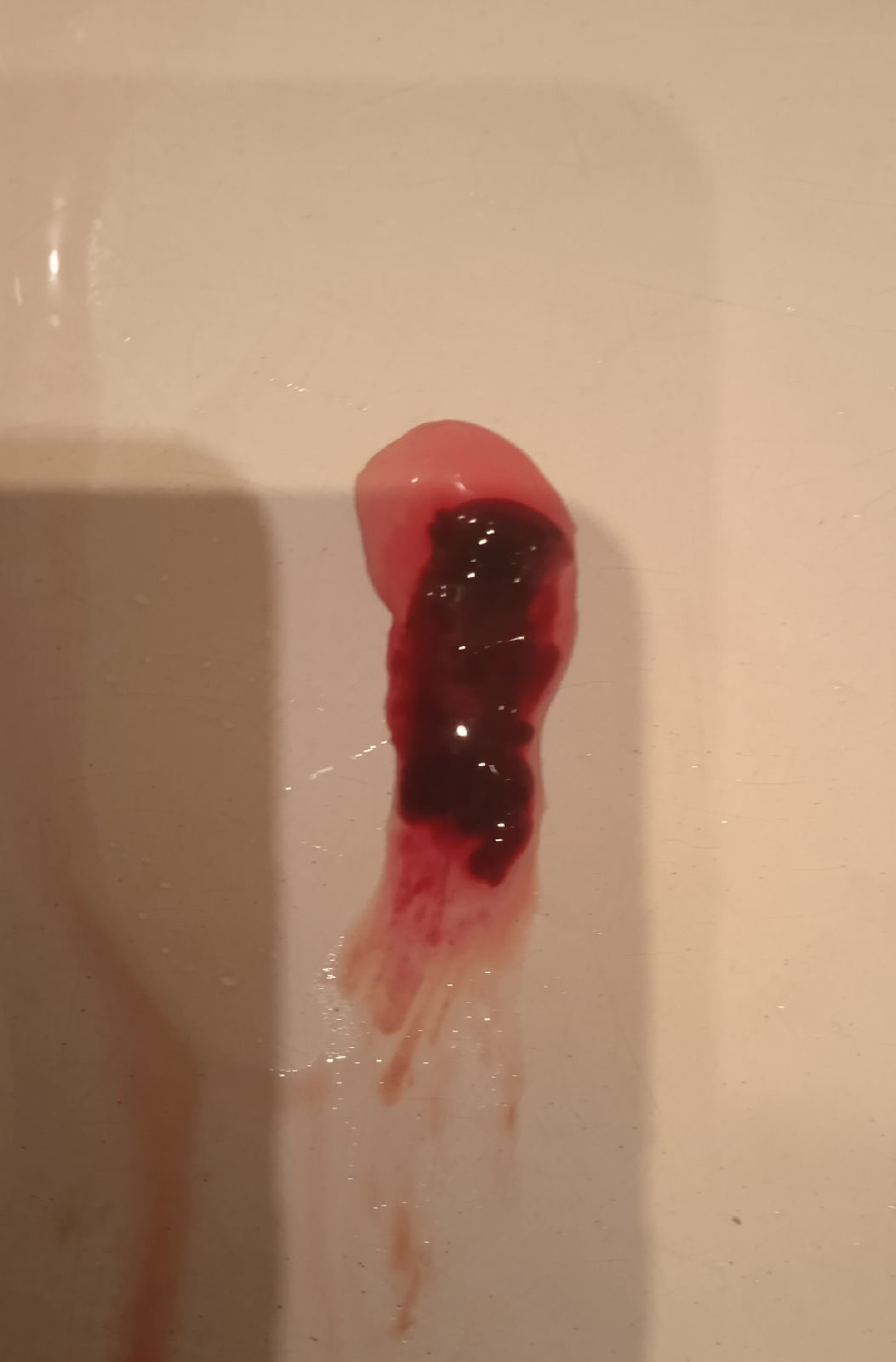 сгустки крови в моче и сперме у мужчин фото 80