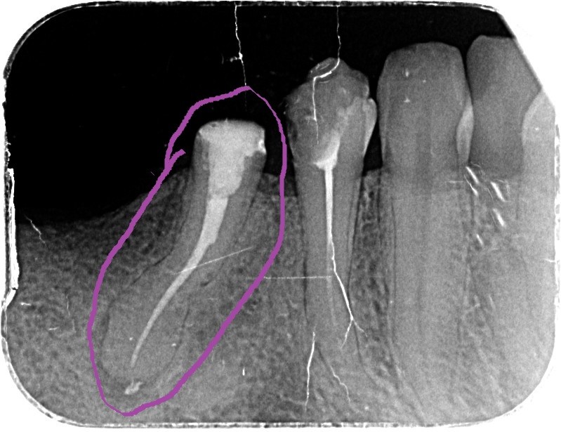 Свищ у корня зуба рентген.