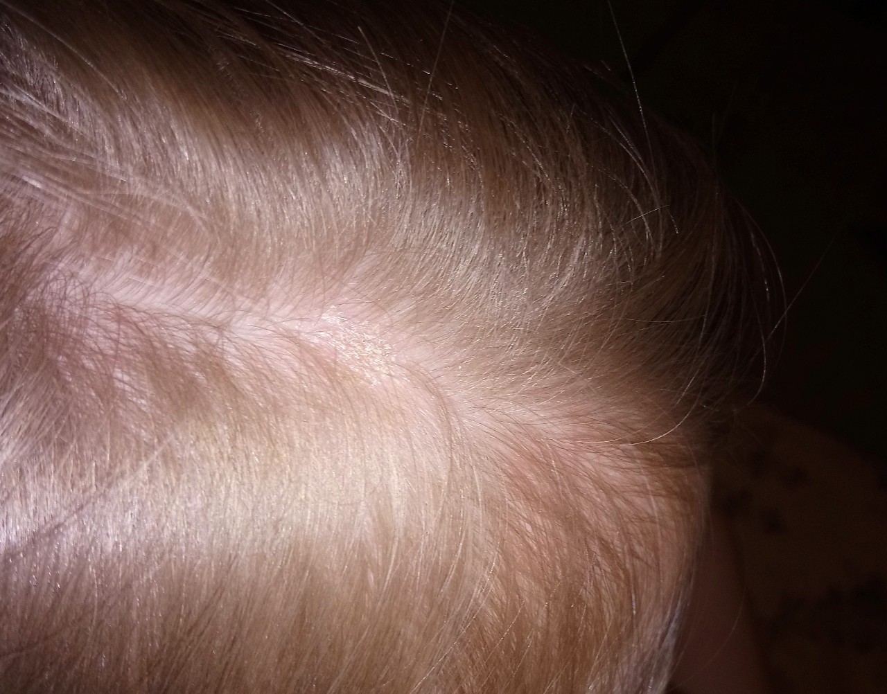 Гемангиома на голове у ребенка фото
