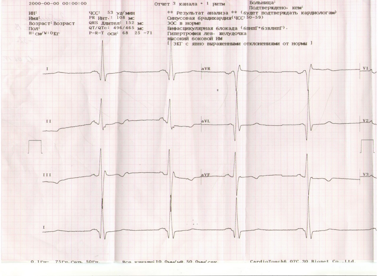 Брадикардия на ЭКГ. Синусовая брадикардия на ЭКГ. Брадикардия ЭКГ фото. Брадикардия плода.