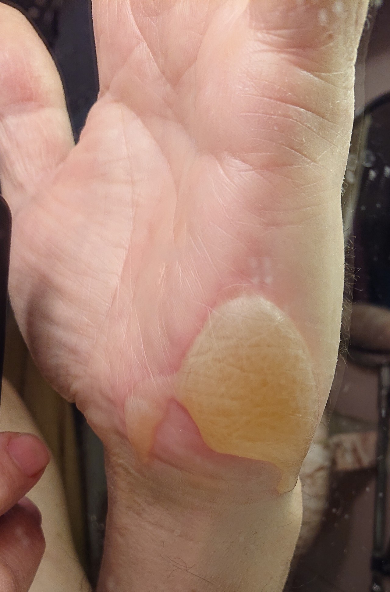 Химический ожог на пальцах рук фото