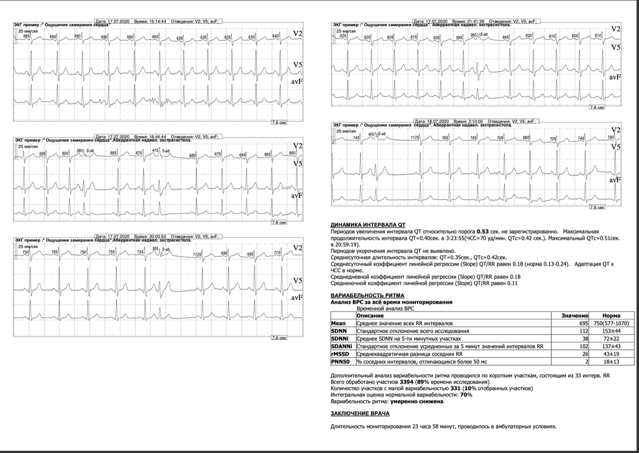 Суточный мониторинг ЭКГ заключение. Пример расшифровки холтера ЭКГ. Протокол расшифровки ЭКГ пример. Суточное мониторирование ЭКГ по Холтеру расшифровка норма.