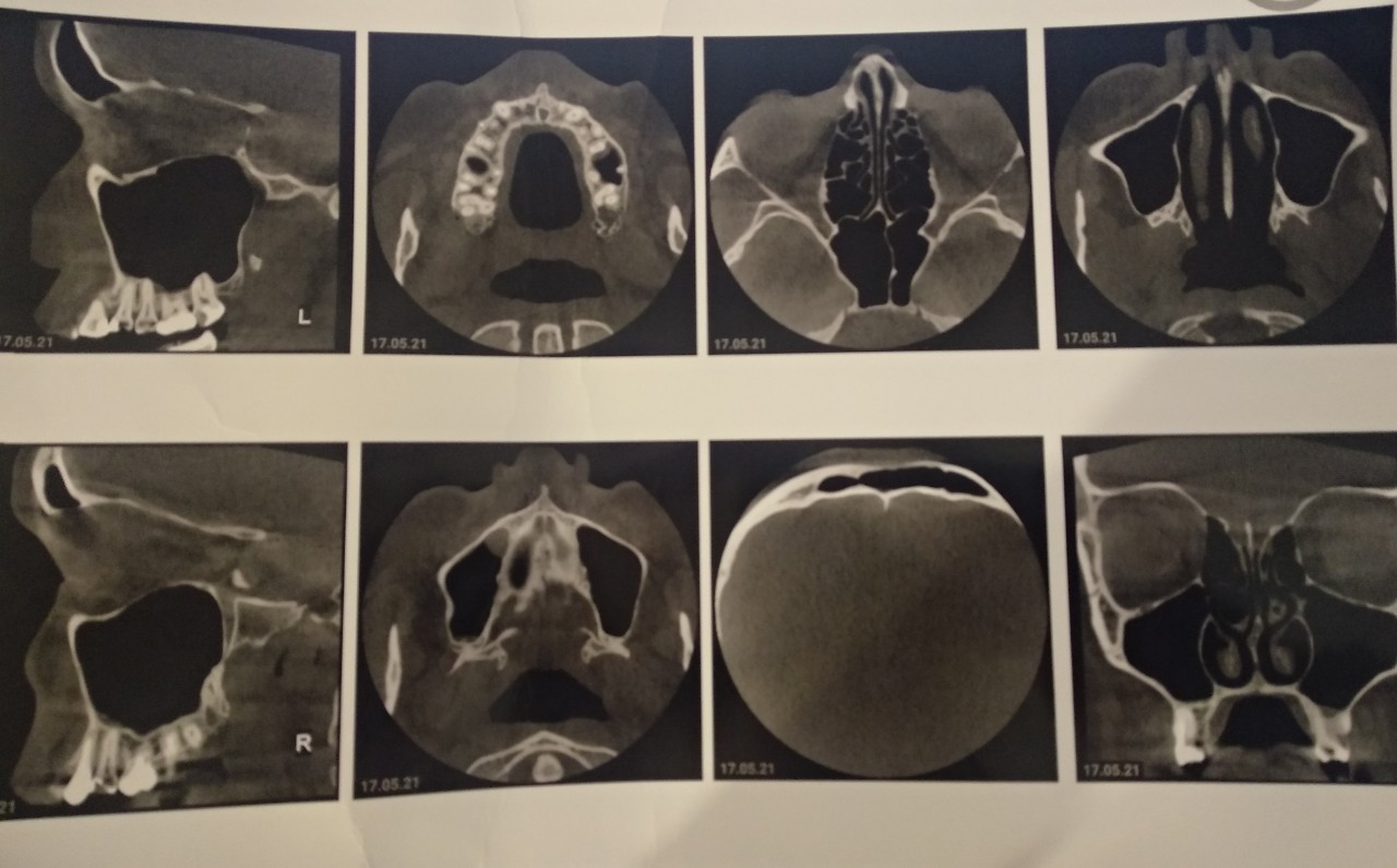 Сделать кт носа. Расшифровка кт пазух носа. Кт носа расшифровка. Кт носовых пазух собаке.