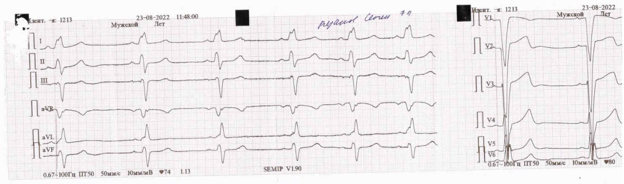 ПБЛНПГ на ЭКГ. ПБЛНПГ. Аневризма ПСЛЖ +ПБЛНПГ. Полная блокада левой ножки пучка Гиса код по мкб 10.