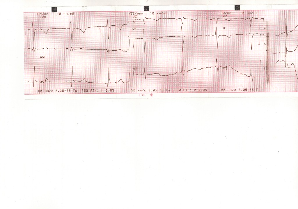 Экг при пролапсе митрального клапана фото