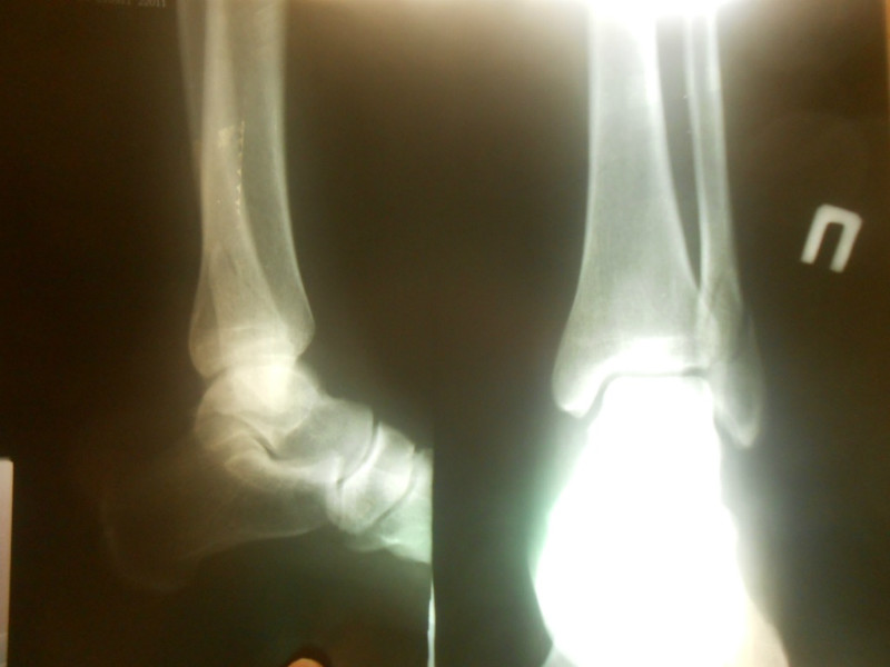 Трещина это перелом. Супинационный перелом лодыжки рентген. Перелом наружной лодыжки рентген. Изолированный перелом лодыжки рентген. Перелом латеральной лодыжки.