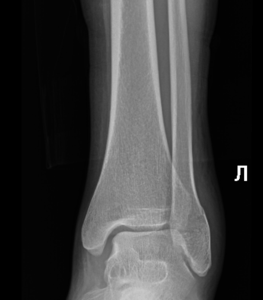 Перелом лодыжки без. Перелом лодыжки без смещения гипс. Трещина в лодыжке без смещения. Трещина голеностопа без смещения. Трещина в лодыжке нужен ли гипс.