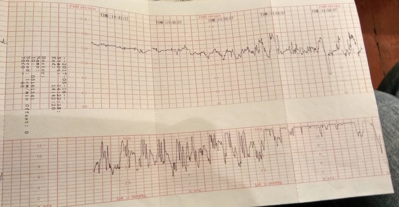 Схватки по ктг фото