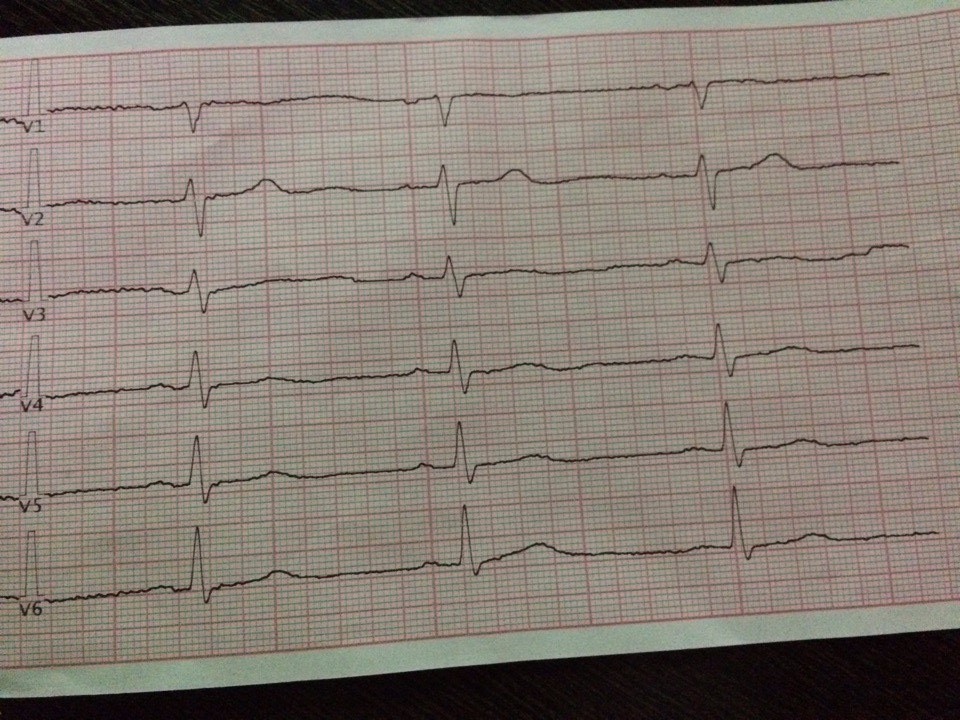 Экг сочи. ЭКГ электрокардиограмма сердца. ЭКГ патологии. Нормальная кардиограмма сердца. ЭКГ больного сердца.