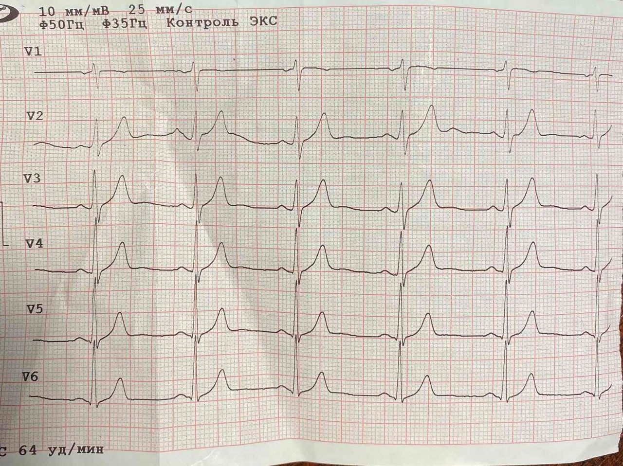 Экг спб. Помогите расшифровать ЭКГ. ЭКГ при одышке. Кардиограмма онлайн.
