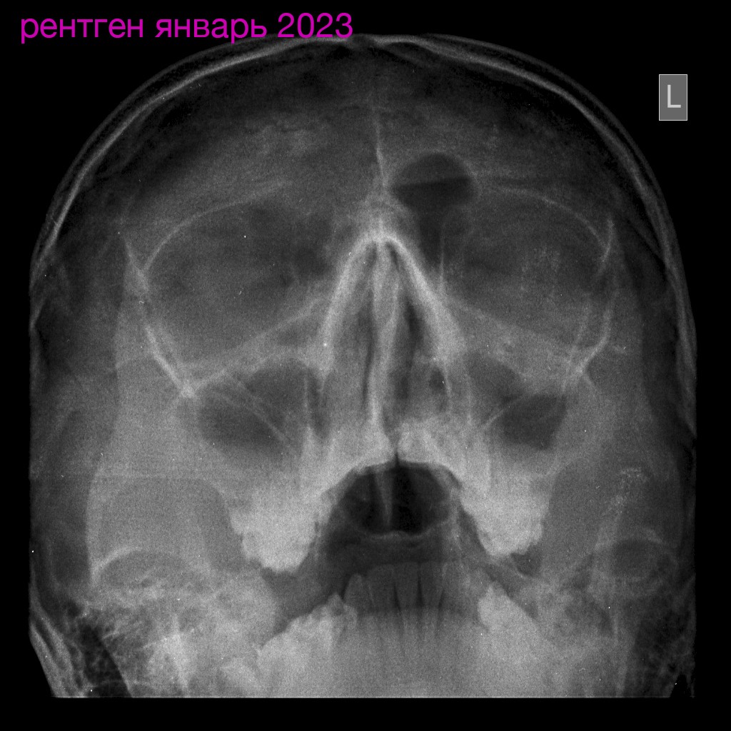 Рентгенологическая картина синусита