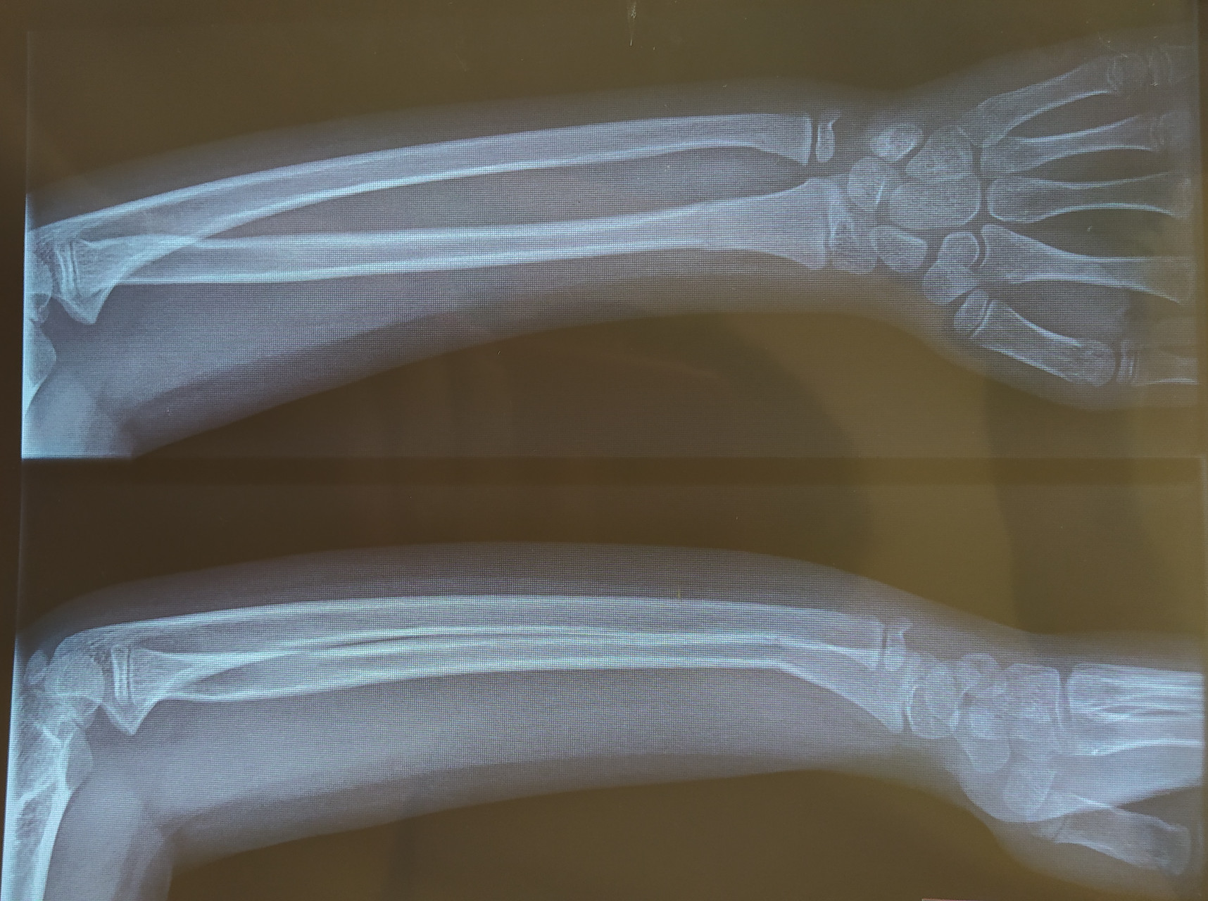 Перелом 3 лучевой кости руки. Перелом лучевой кости без смещения рентген снимок.