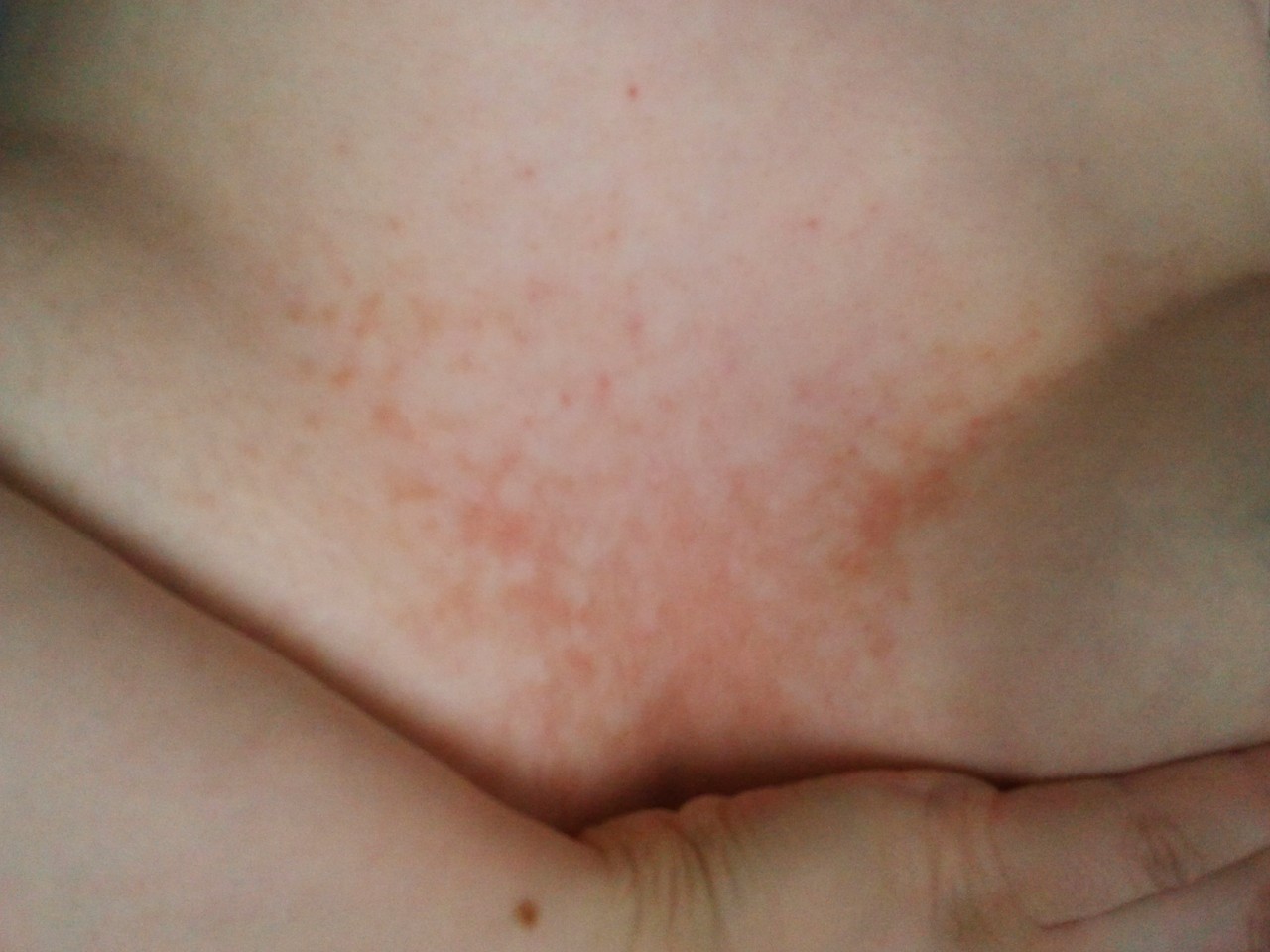 сыпь на груди животе при беременности фото 42
