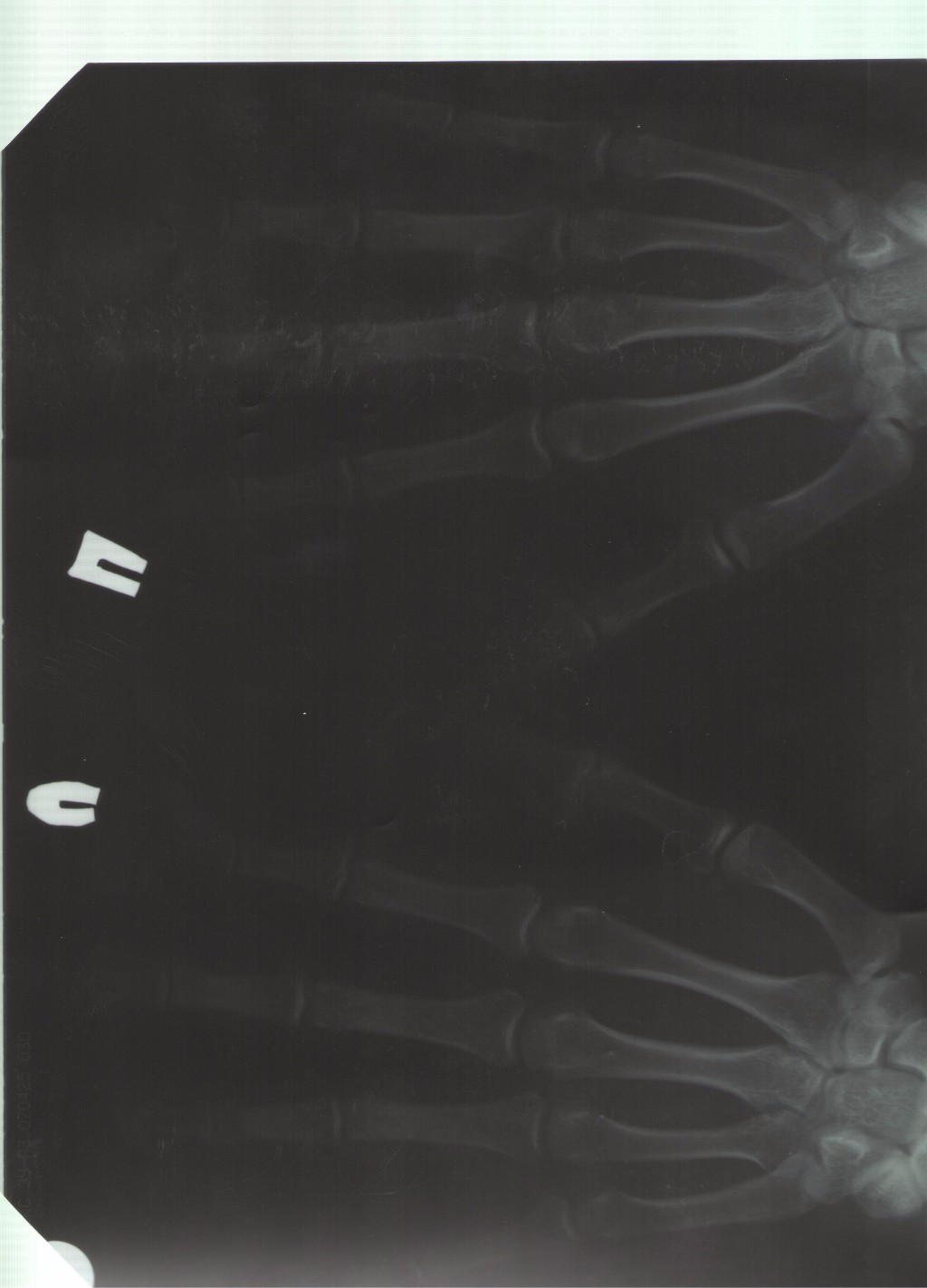 Затемнение на месте штифта рентген кисти. Рентген здоровой кисти левой руки. Зона роста Мем. Блокирование зон роста бабочка.