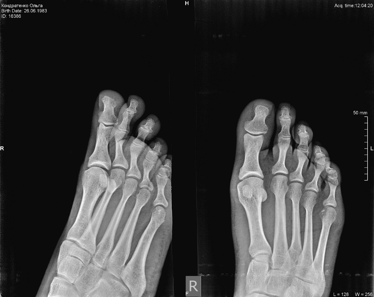 Ногтевая фаланга ноги. Перелом 5 пальца стопы рентген. Перелом фаланги большого пальца стопы рентген. Перелом основной фаланги 5 пальца ноги рентген. Перелом фаланги пальца рентген.