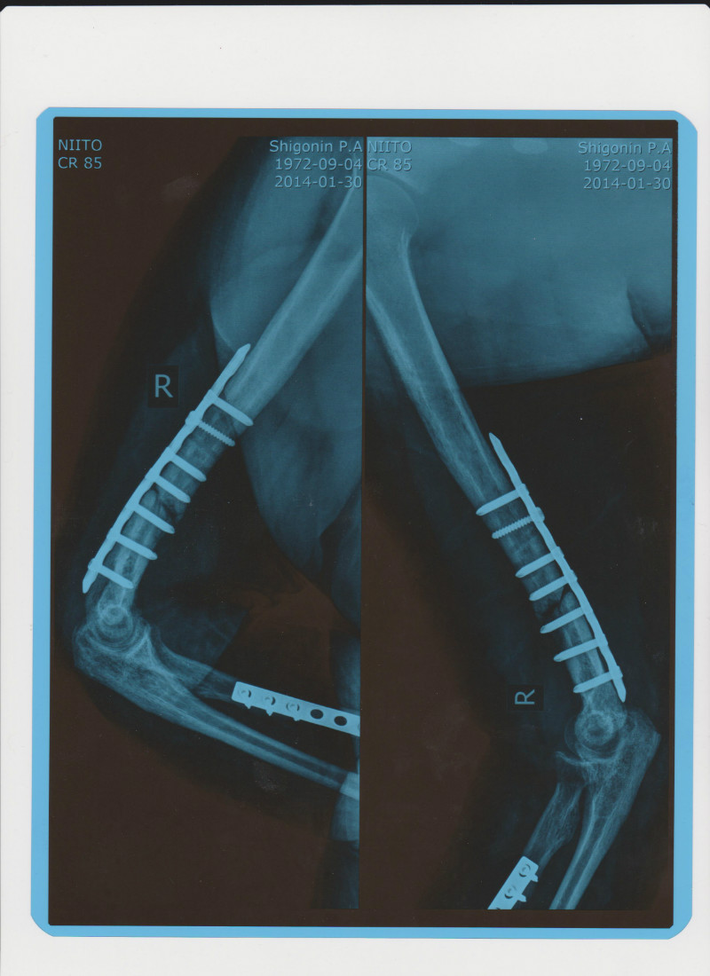 Перелом н 3. Остеосинтез пластиной плечевой кости в н/3. Пластина титановая для плечевой кости. Перелом плечевой кости пластина. Титановые пластины для костей ног.