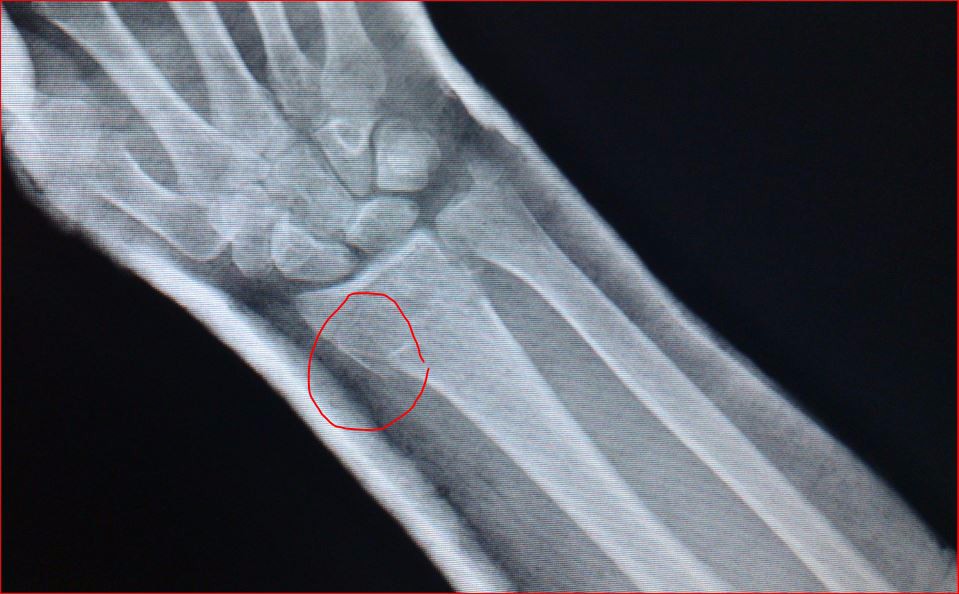 Снимок трещины. Лучевая кость на руке рентген перелом. Рентген снимок лучевой кости правой руки. Рентген перелома лучевой кости руки. Краевой перелом правой лучевой кости.