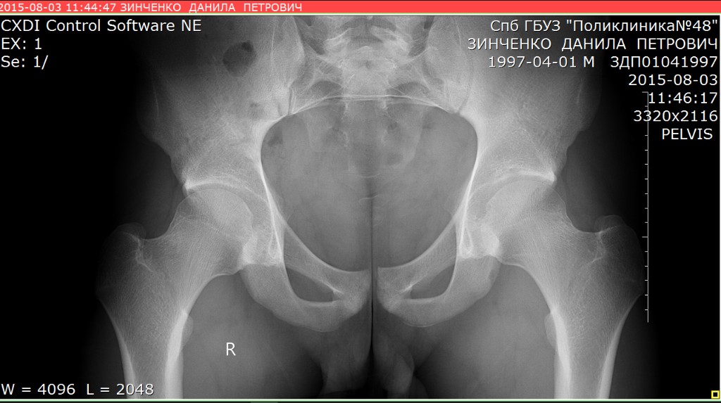 Тазобедренный сустав рентген анатомия. Боль в тазобедренном суставе. Тазобедренный сустав болит. Щелкает тазобедренный сустав. Форум после тазобедренной операции