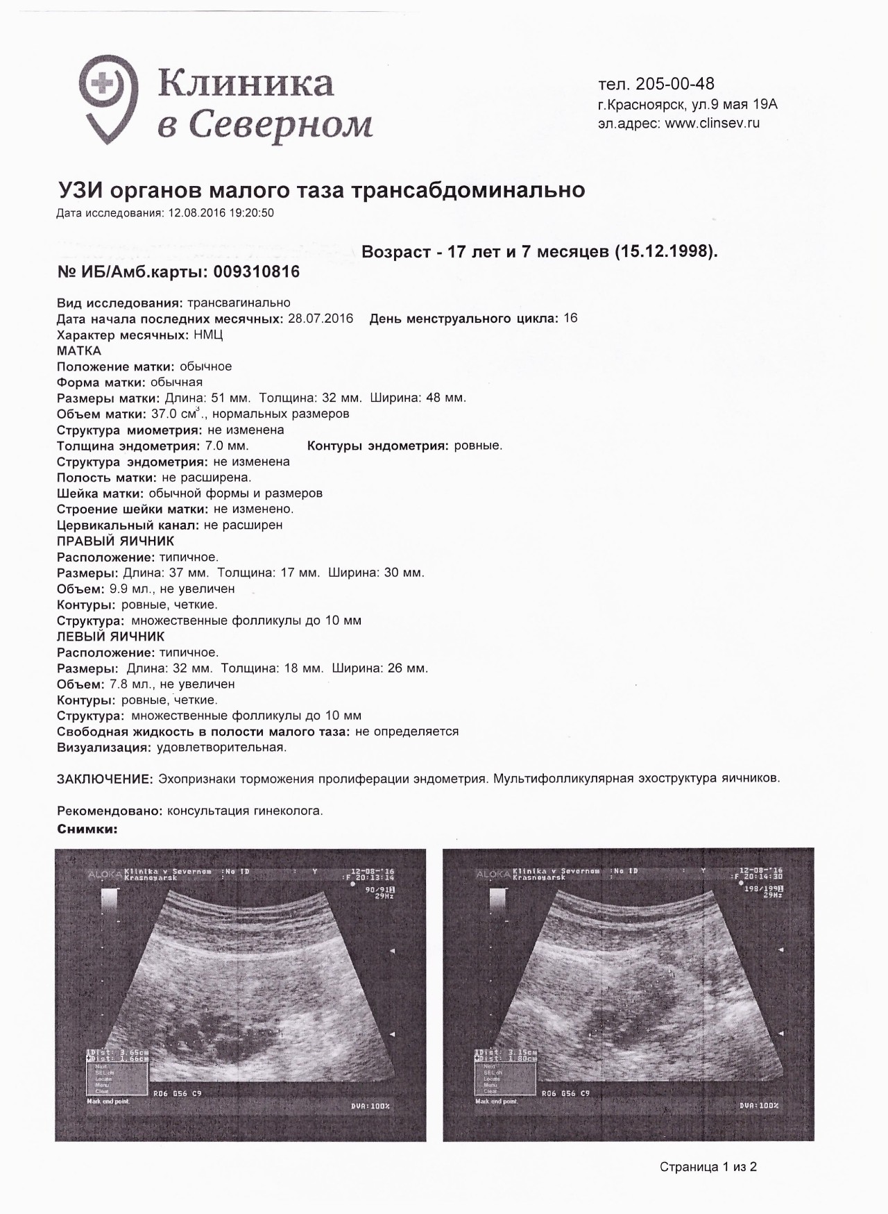 Размер полости матки. Полип эндометрия УЗИ протокол. Расширение полости матки по УЗИ заключение. Трансабдоминальное УЗИ матки. Хронический эндометрит УЗИ.