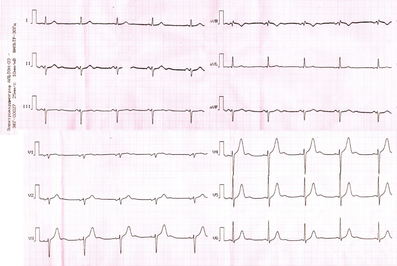 Экг очаговые. ЭКГ фото. ЭКГ картинки.