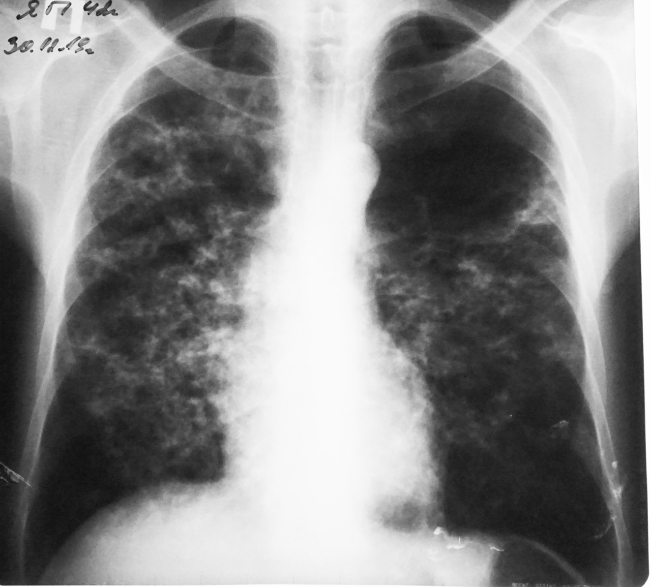 Снимки туберкулеза легких у взрослых