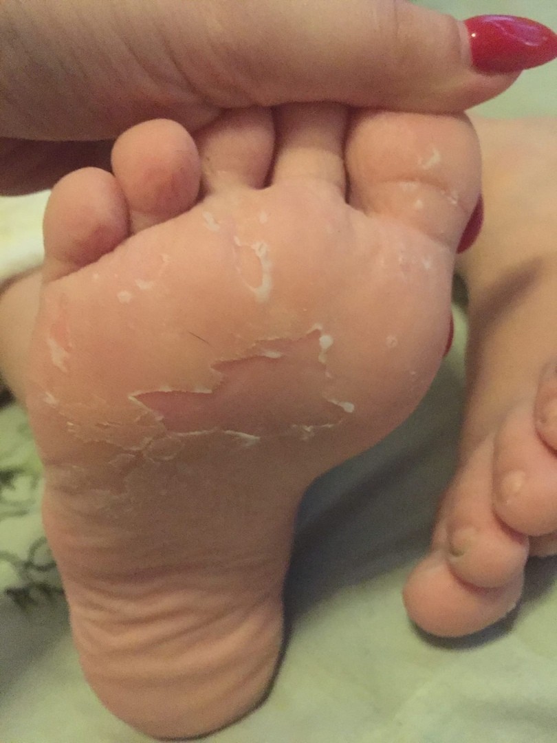Грубая кожа на ногах у ребенка