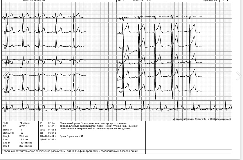 Кардиограмма сердца расшифровка норма таблица
