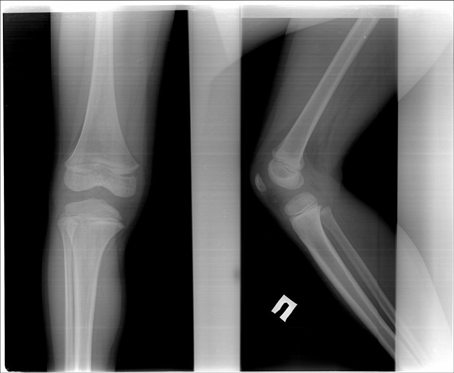 Эпифизарная дисплазия голеней рентген. Эпифизеолиз лучевой кости рентген. Эпифизеолиз локтевой кости. Эпифизеолиз плечевой кости рентген. Эпифизеолиз локтевого сустава.