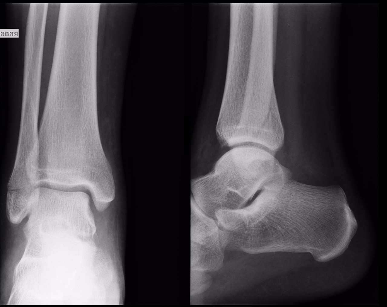 Рентген ноги фото голеностопа человека