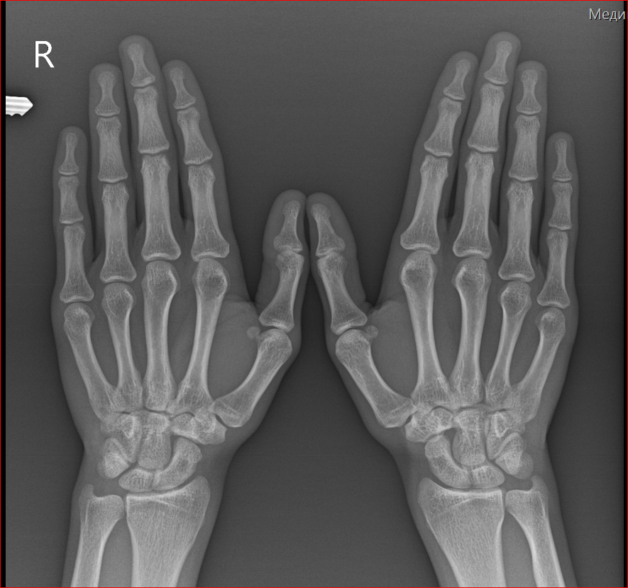 Зона открытий. Зоны роста костей. Зоны роста кисти. Зоны роста на рентгене кисти. Зоны роста костей на рентгене.