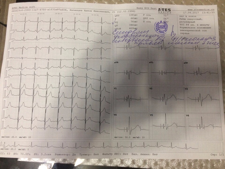 Плохая кардиограмма сердца у взрослого фото