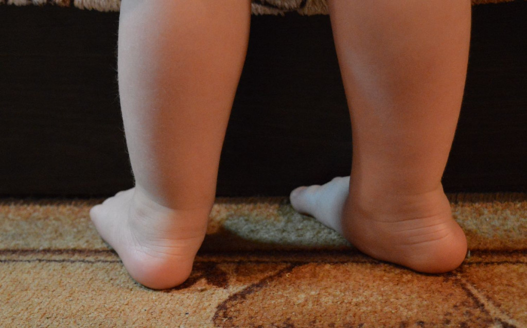 Вальгусная деформация стопы москва. Плоско-вальгусная деформация стоп. Плосковальгусные стопы у детей.