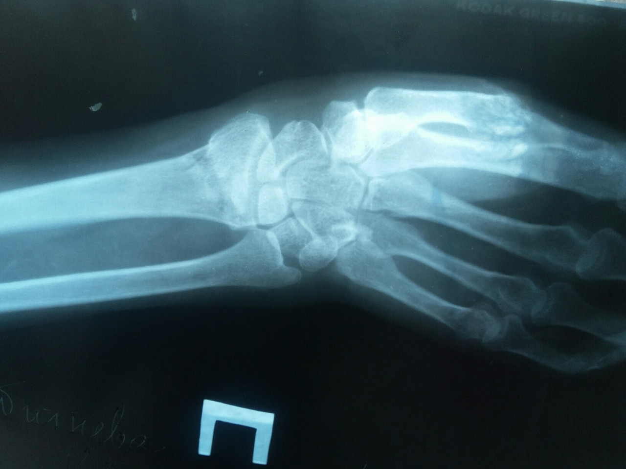Лучевая трещина. Перелом ДМЭ лучевой кости. Перелом лучевой запястной кости. Перелом лучевой кости рентген снимок. Рентген перелома лучевой кости руки.
