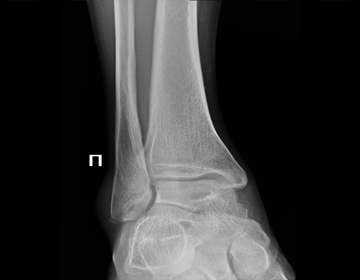 Перелом правой лодыжки со смещением