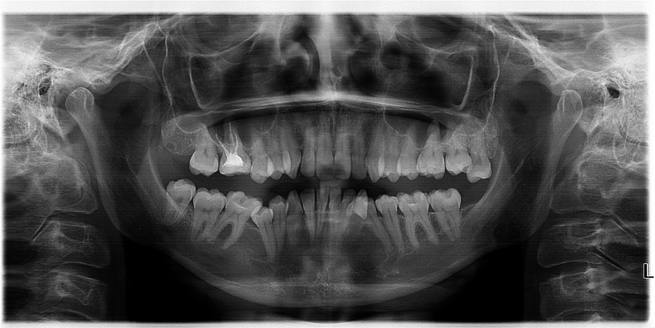 Снимок зуба мудрости. Рентген верхнего зуба мудрости. Рентген верхних зубов мудрости. Снимок здоровых зубов мудрости.