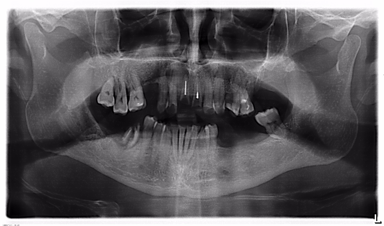Как выглядят зубы на снимке. Ортопантомограмма киста зуба. Ортопантомограмма синусит.