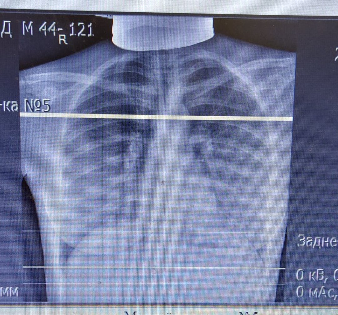 Рентген грудной клетки фото как делают