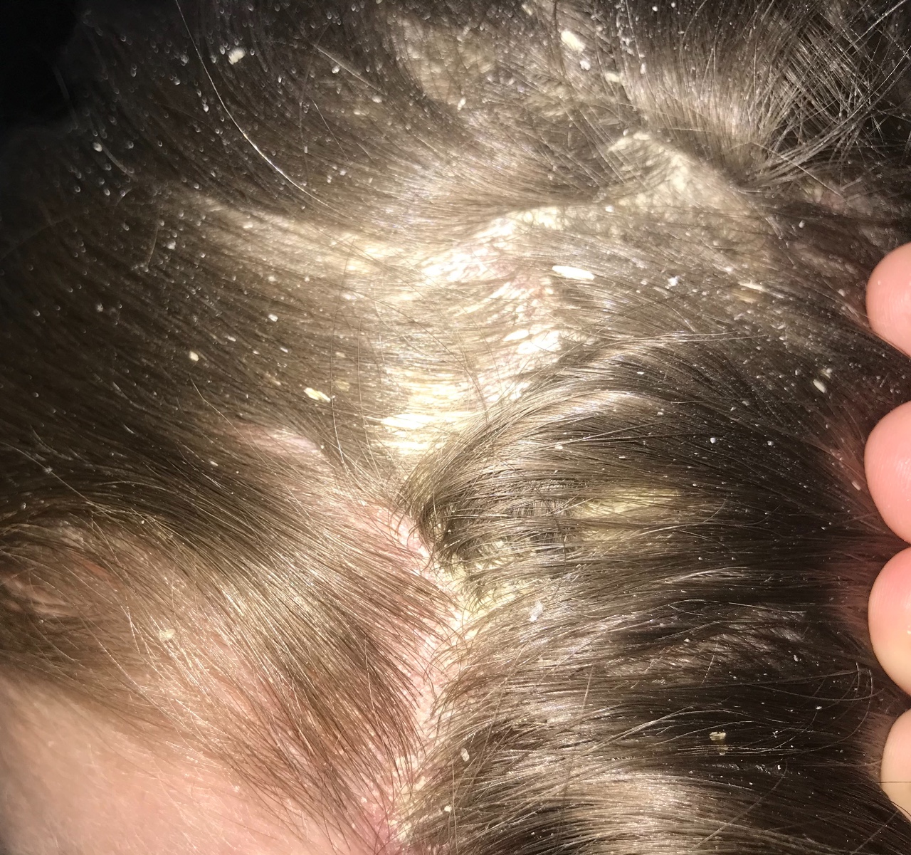 псориаз волосистой части головы фото