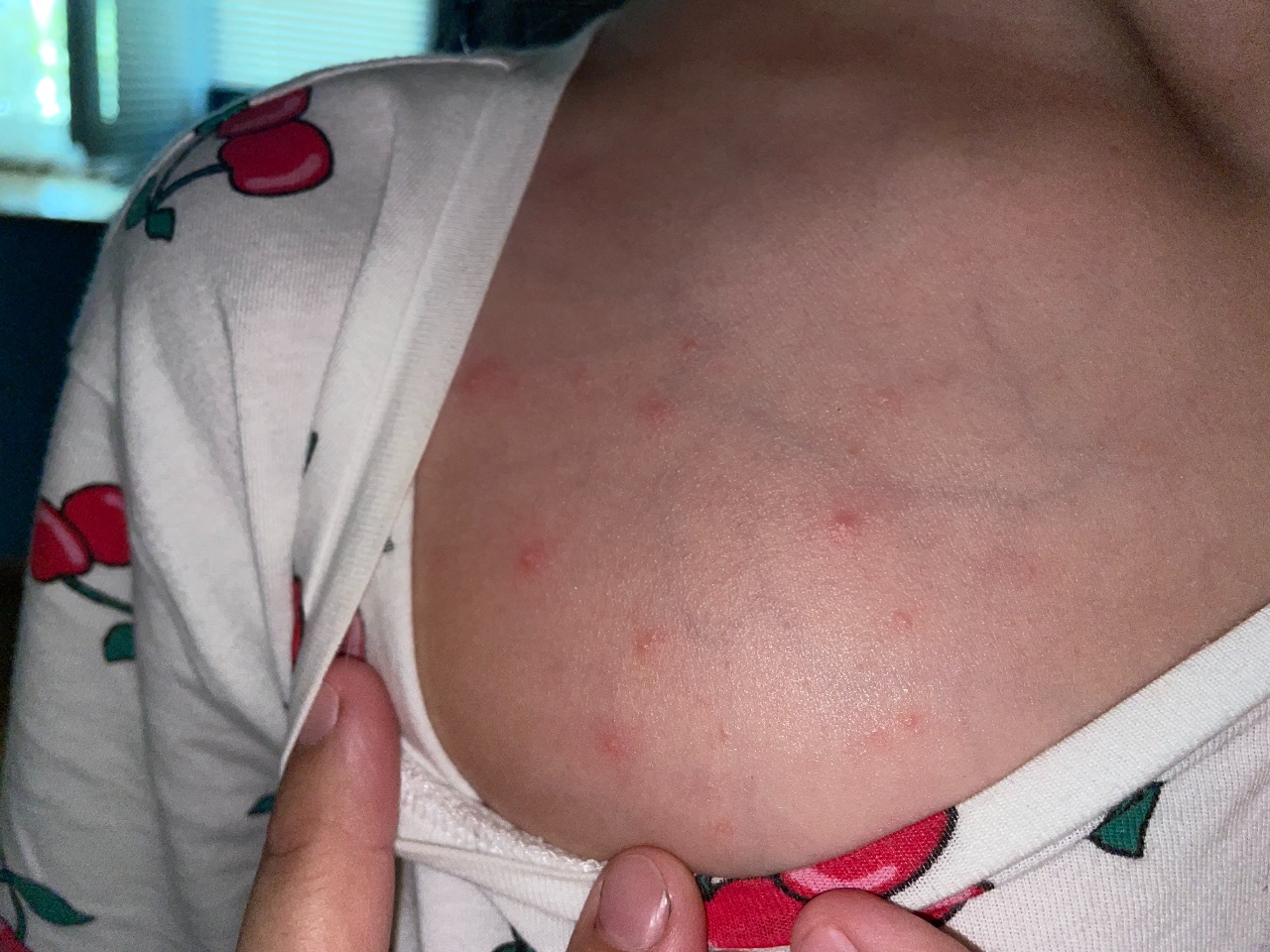 аллергия на грудях у кормящей мамы фото 19