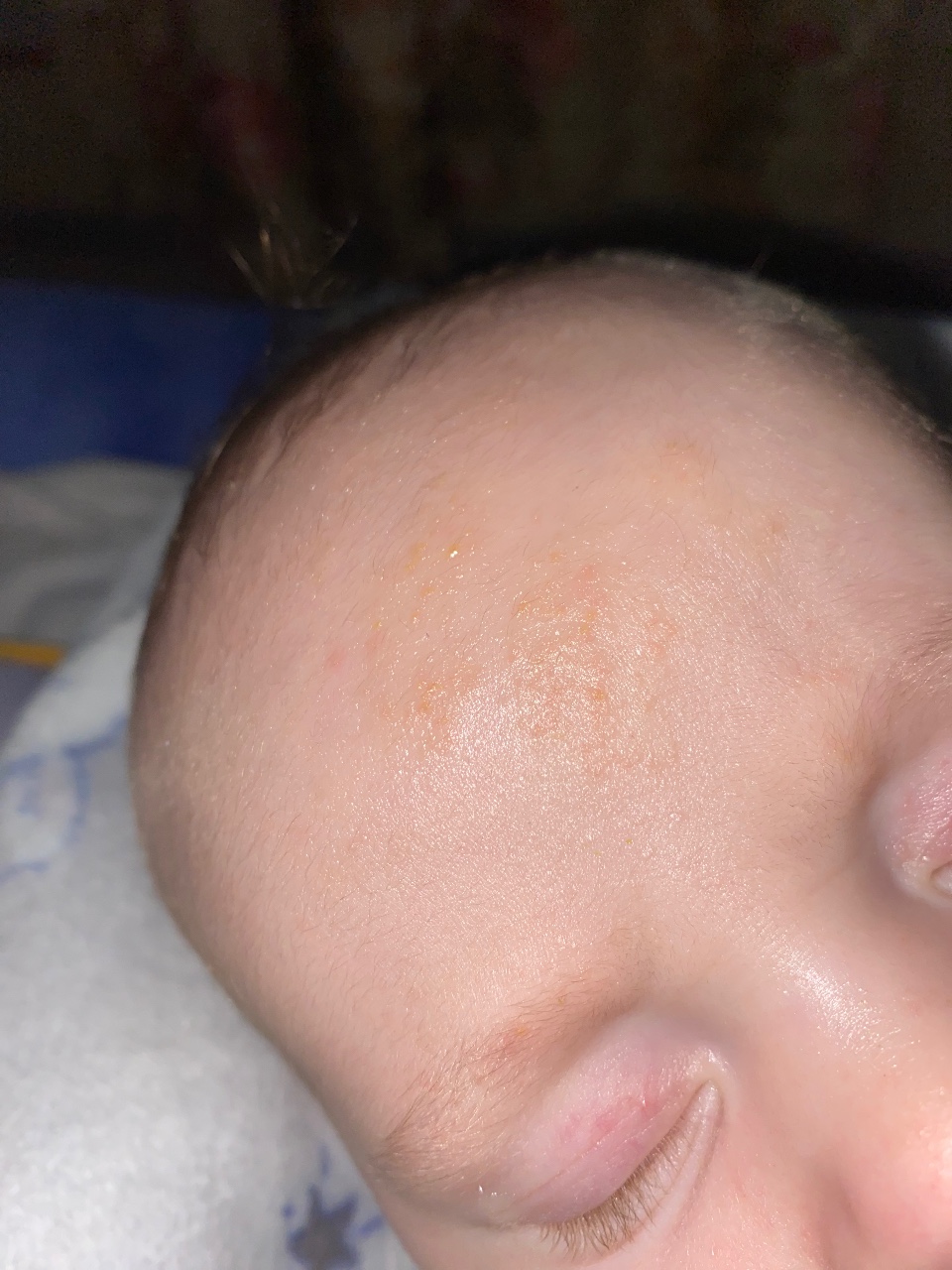 сыпь на голове у ребенка фото