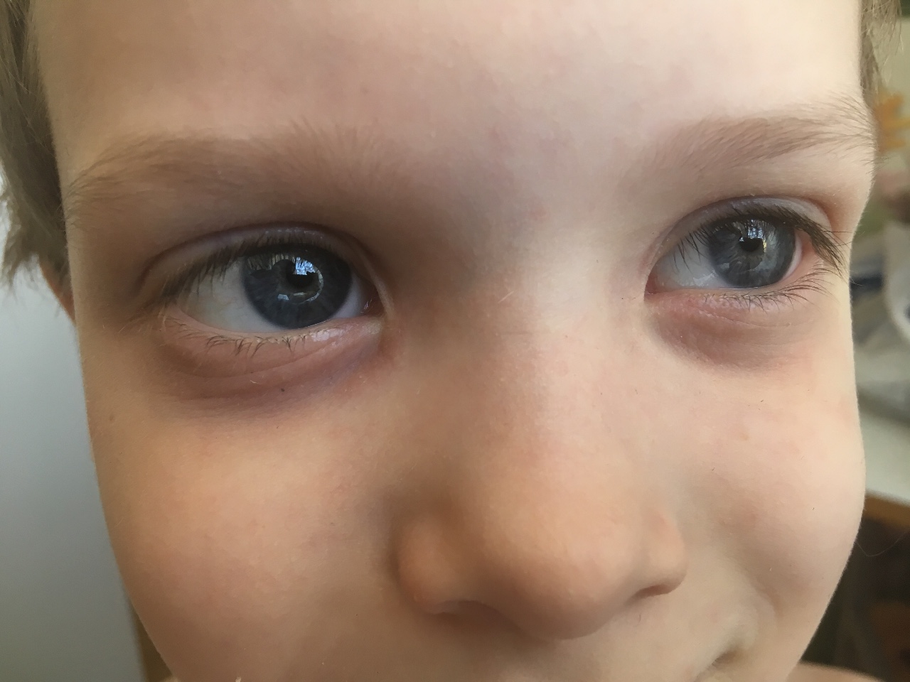 Почему у ребенка голубые глаза. Синячки под глазами у ребенка. Синякитподтшлазами у ребенка. Синие круги под глазами у ребенка.