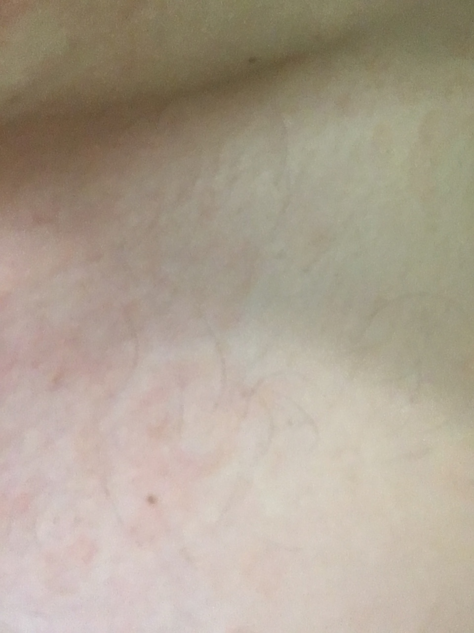 светло коричневые пятна на груди у женщин фото 42