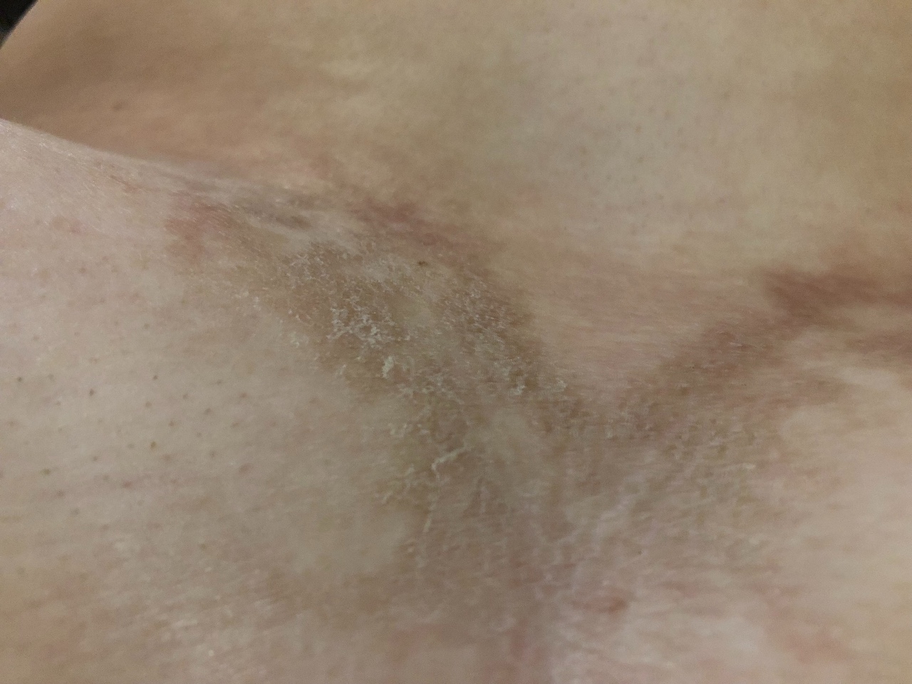 светло коричневые пятна на груди у женщин фото 27