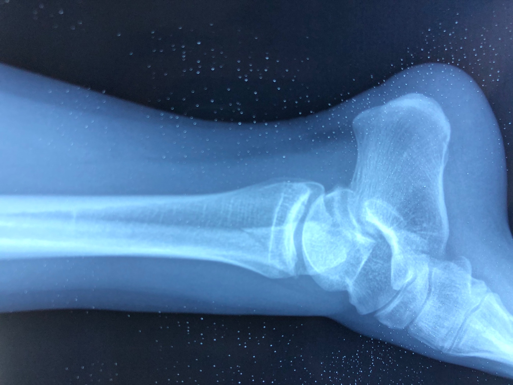 Перелом малой берцовой ноги - Вопрос ортопеду-травматологу - 03 Онлайн