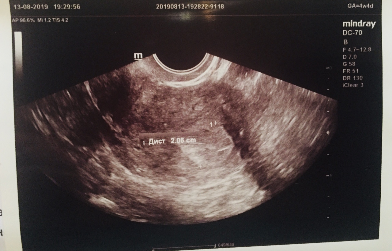 беременность 5 недели грудь фото 72