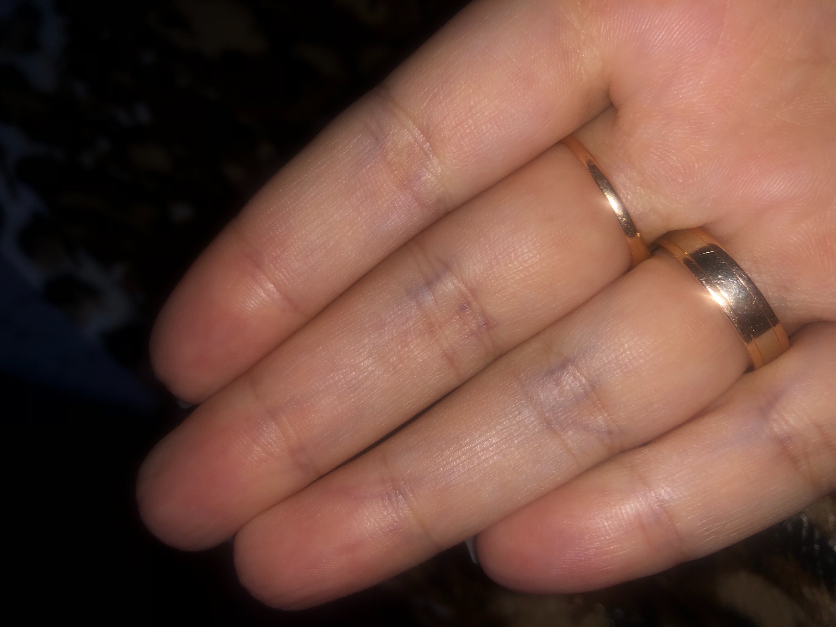 Почему палец черный от золотого кольца. Уплотнение на фаланге пальца. Вена на указательном пальце.