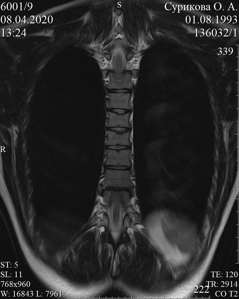 Правосторонний сколиоз грудного отдела фото
