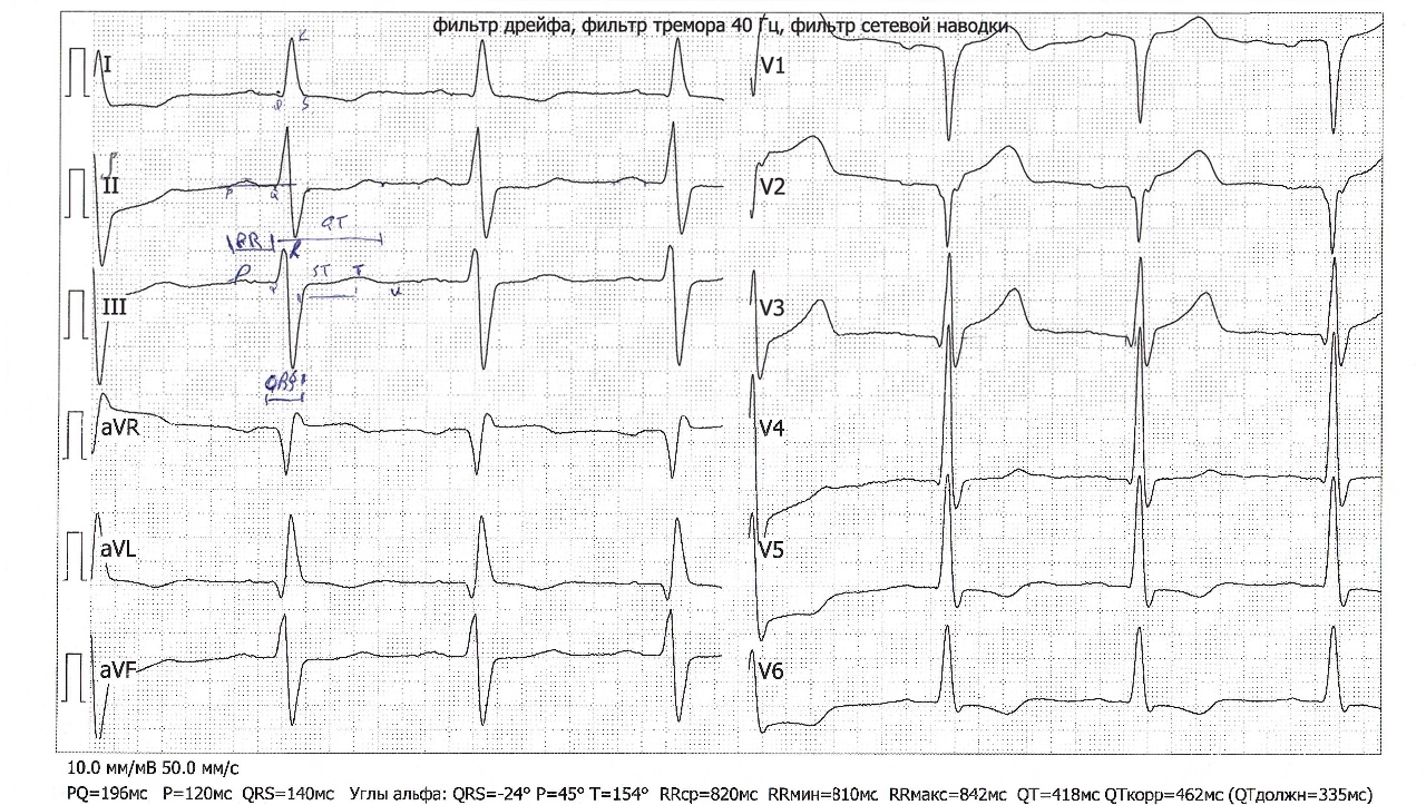 Патологии на экг фото с расшифровкой